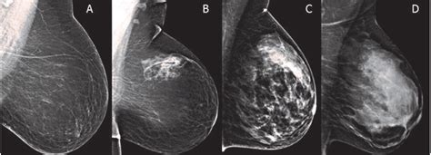 Compared with women with scattered fibroglandular densities, those with heterogeneously or extremely dense breasts were more likely to be Asian . . Is scattered fibroglandular densities cancer